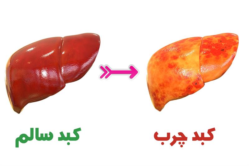 کبد چرب بیماری شایع جوامع امروز